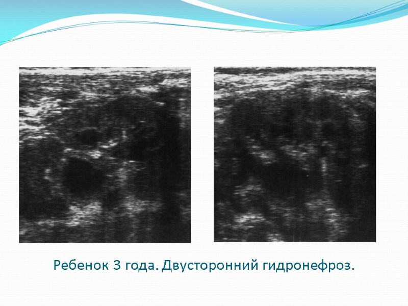 Ребенок 3 года. Двусторонний гидронефроз.